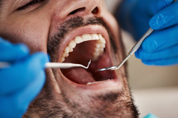Best Emergency Tooth Extraction in West Bend, WI